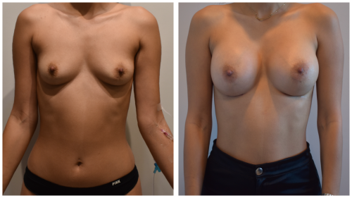 BeforeAfter-b1428 