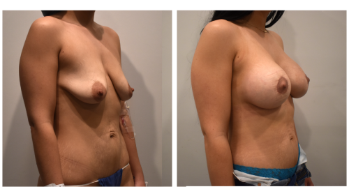 BeforeAfter-b1429 34