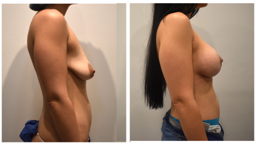 BeforeAfter-b1429 Right