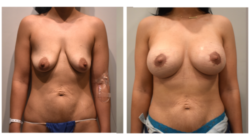 BeforeAfter-b1429 Center