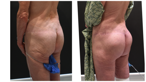 ButliftBeforeAfter 34
