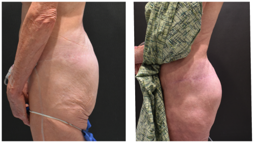 ButliftBeforeAfter Right