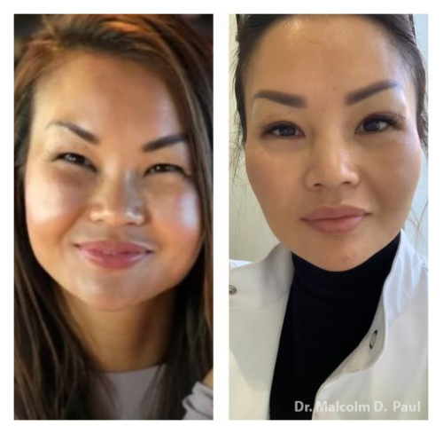 Pre and post op Asian blepharoplasties and buccal fat pad removal