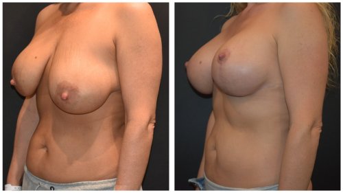 Case1458- Case1458- angle