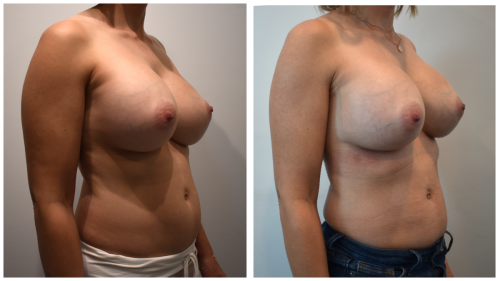 Reduction-before-after 34