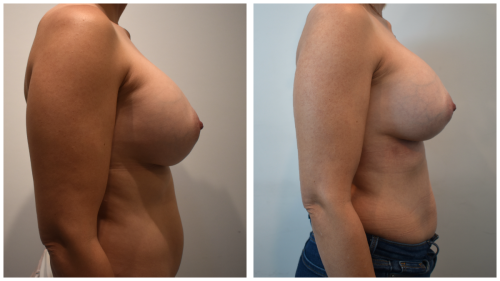 Reduction-before-after Right