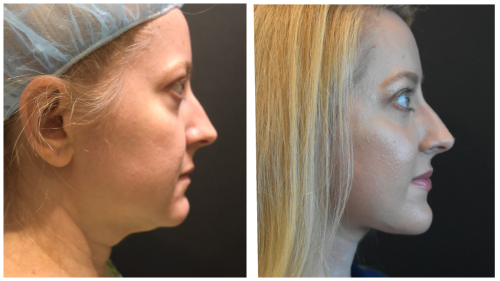 SubmentalBeforeAfter Right