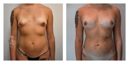 Fat Transfer to Breasts