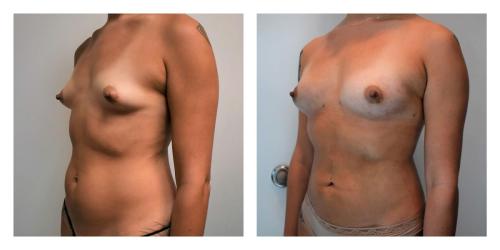 Fat Transfer to Breasts