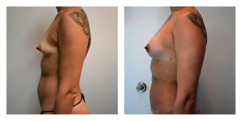 Fat Transfer to Breasts