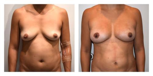 Fat Transfer to Breasts