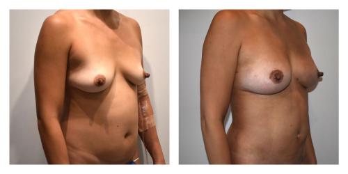 Fat Transfer to Breasts