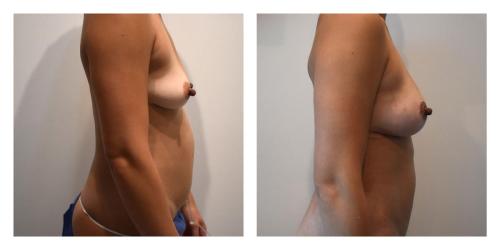 Fat Transfer to Breasts