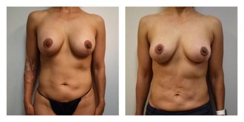 Remove Implants and Fat Transfer to Breasts