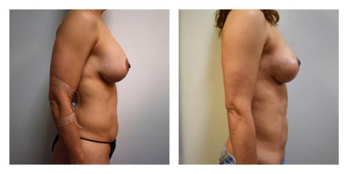 Remove Implants and Fat Transfer to Breasts