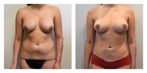 Remove Implants and Fat Transfer to Breasts