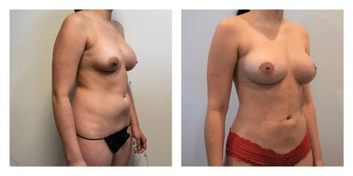 Remove Implants and Fat Transfer to Breasts