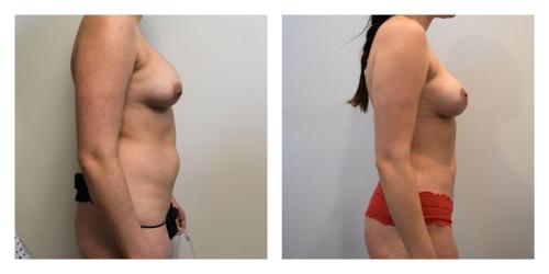 Remove Implants and Fat Transfer to Breasts