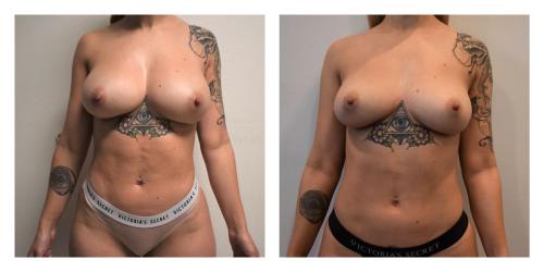 Remove Implants and Fat Transfer to Breasts