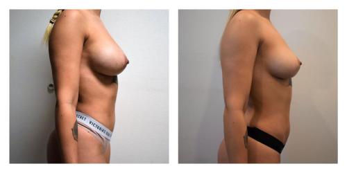 Remove Implants and Fat Transfer to Breasts