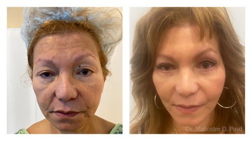 Pre Op Blepharoplasties Face and Necklift