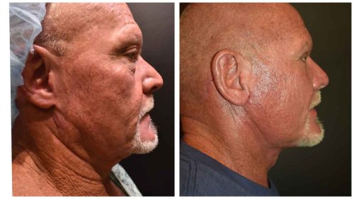 Before and After - side