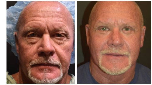 Before and After - front